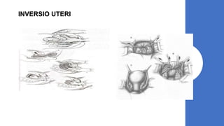 INVERSIO UTERI
 