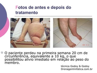 Fotos de antes e depois do
tratamento
 O paciente perdeu na primeira semana 20 cm de
circunferência, equivalente a 10 kg, o que
possibilitou alivio imediato em relação ao peso do
membro.
técnica Godoy & Godoy
Drenagemlinfatica.com.br
 