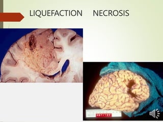 LIQUEFACTION NECROSIS
 