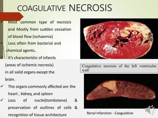 COAGULATIVE NECROSIS
 Most common type of necrosis
and Mostly from sudden cessation
of blood flow (ischaemia)
 Less often from bacterial and
chemical agents.
 It’s characteristic of infarcts
(areas of ischemic necrosis)
in all solid organs except the
brain.
 The organs commonly affected are the
heart , kidney, and spleen
 Loss of nuclei(tombstone) &
preservation of outlines of cells &
recognition of tissue architecture
Coagulative necrosis of the left ventricular
wall
Renal Infarction - Coagulative
 