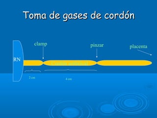 Toma de gases de cordónToma de gases de cordón
2 cm 4 cm
clamp pinzar
RN
Cordón umbilical
placenta
 
