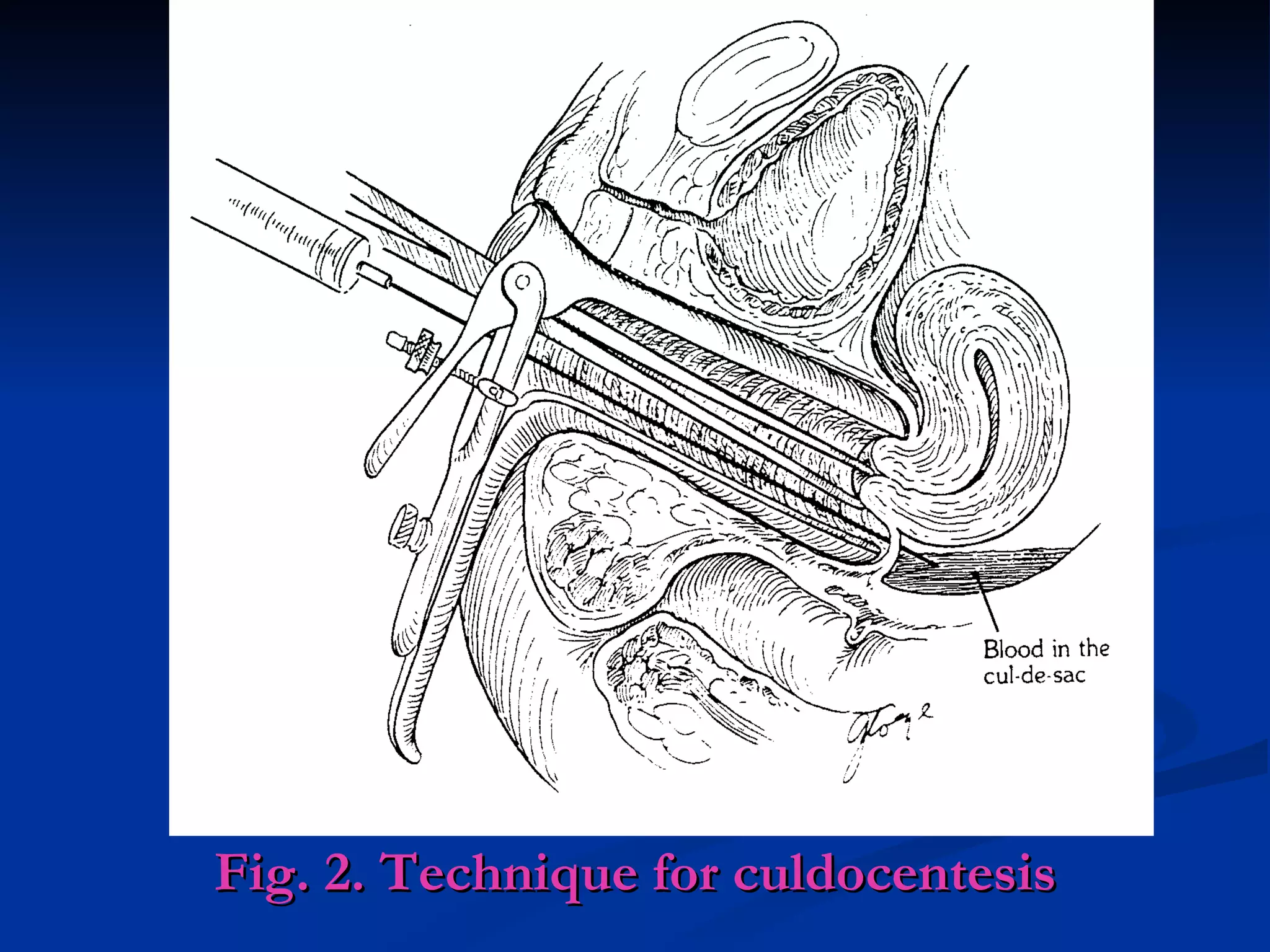Fig. 2. Technique for culdocentesis 