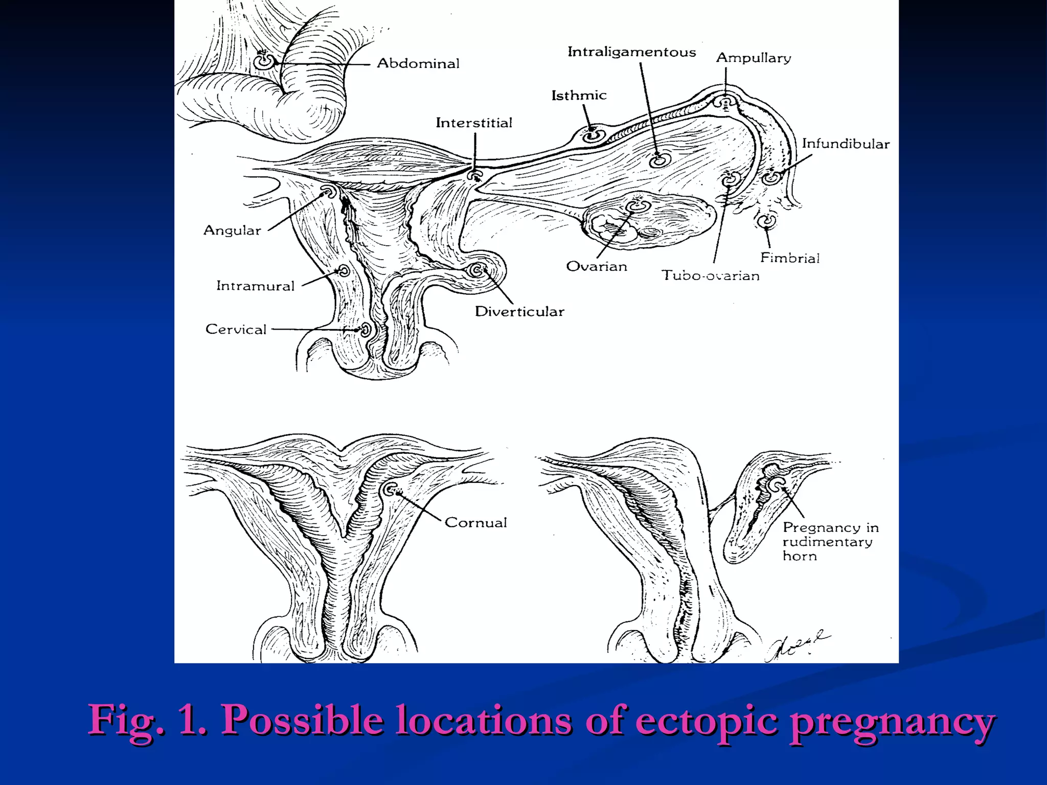 Fig. 1. Possible locations of ectopic pregnancy 