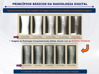 Técnicas impróprias com receptor de imagem convencional resultam em péssimas imagens
 Imagens da Radiologia Computadorizada obtidas através com as MESMAS TÉCNICAS
 O contraste não muda com a variação da exposição a radiação
PRINCÍPIOS BÁSICOS DA RADIOLOGIA DIGITAL
 
