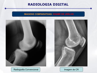 Radiografia Convencional Imagem de CR
RADIOLOGIA DIGITAL
IMAGENS COMPARATIVAS: EXAME DE JOELHO
 