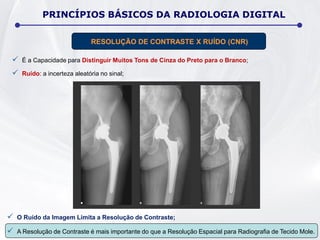 É a Capacidade para Distinguir Muitos Tons de Cinza do Preto para o Branco;
 Ruído: a incerteza aleatória no sinal;
PRINCÍPIOS BÁSICOS DA RADIOLOGIA DIGITAL
RESOLUÇÃO DE CONTRASTE X RUÍDO (CNR)
 O Ruído da Imagem Limita a Resolução de Contraste;
 A Resolução de Contraste é mais importante do que a Resolução Espacial para Radiografia de Tecido Mole.
 