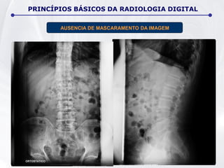 AUSENCIA DE MASCARAMENTO DA IMAGEM
PRINCÍPIOS BÁSICOS DA RADIOLOGIA DIGITAL
 