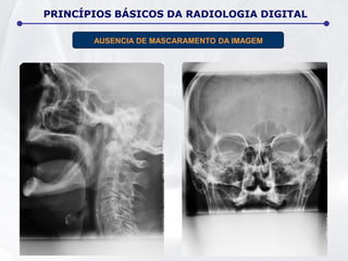 AUSENCIA DE MASCARAMENTO DA IMAGEM
PRINCÍPIOS BÁSICOS DA RADIOLOGIA DIGITAL
 