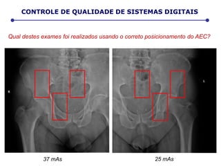 37 mAs 25 mAs
Qual destes exames foi realizados usando o correto posicionamento do AEC?
CONTROLE DE QUALIDADE DE SISTEMAS DIGITAIS
 