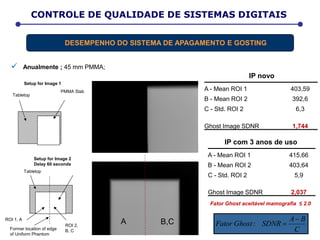 Setup for Image 1
Tabletop
PMMA Slab
Setup for Image 2
Delay 60 seconds
Former location of edge
of Uniform Phantom
Tabletop
ROI 1, A
ROI 2,
B, C
 Anualmente ; 45 mm PMMA;
C
BA
SDNRGhostFator

:A B,C
D E T E R M I N A Ç Ã O D A D O S E E F E T I V ACONTROLE DE QUALIDADE DE SISTEMAS DIGITAIS
DESEMPENHO DO SISTEMA DE APAGAMENTO E GOSTING
A - Mean ROI 1 415,66
B - Mean ROI 2 403,64
C - Std. ROI 2 5,9
Ghost Image SDNR 2,037
A - Mean ROI 1 403,59
B - Mean ROI 2 392,6
C - Std. ROI 2 6,3
Ghost Image SDNR 1,744
IP com 3 anos de uso
IP novo
Fator Ghost aceitável mamografia ≤ 2.0
 