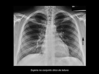 Sujeira no conjunto ótico de leitura
 