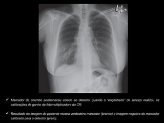 Marcador de chumbo permaneceu colado ao detector quando o “engenheiro” de serviço realizou as
calibrações de ganho da fotomultiplicadora do CR.
 Resultado na imagem do paciente mostra verdadeiro marcador (branco) e imagem negativa do marcador
calibrado para o detector (preto).
 