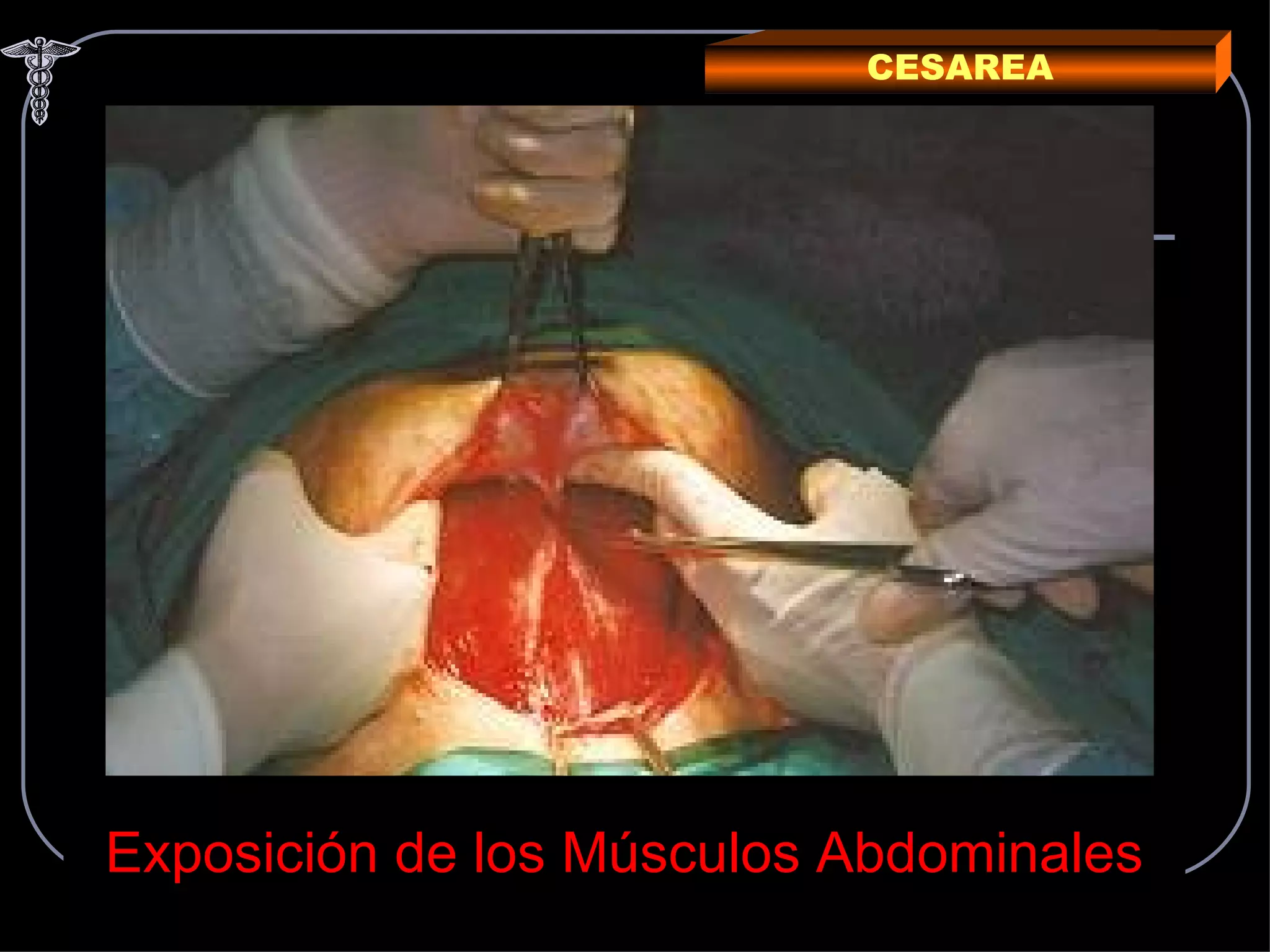 CESAREA Exposición de los Músculos Abdominales 