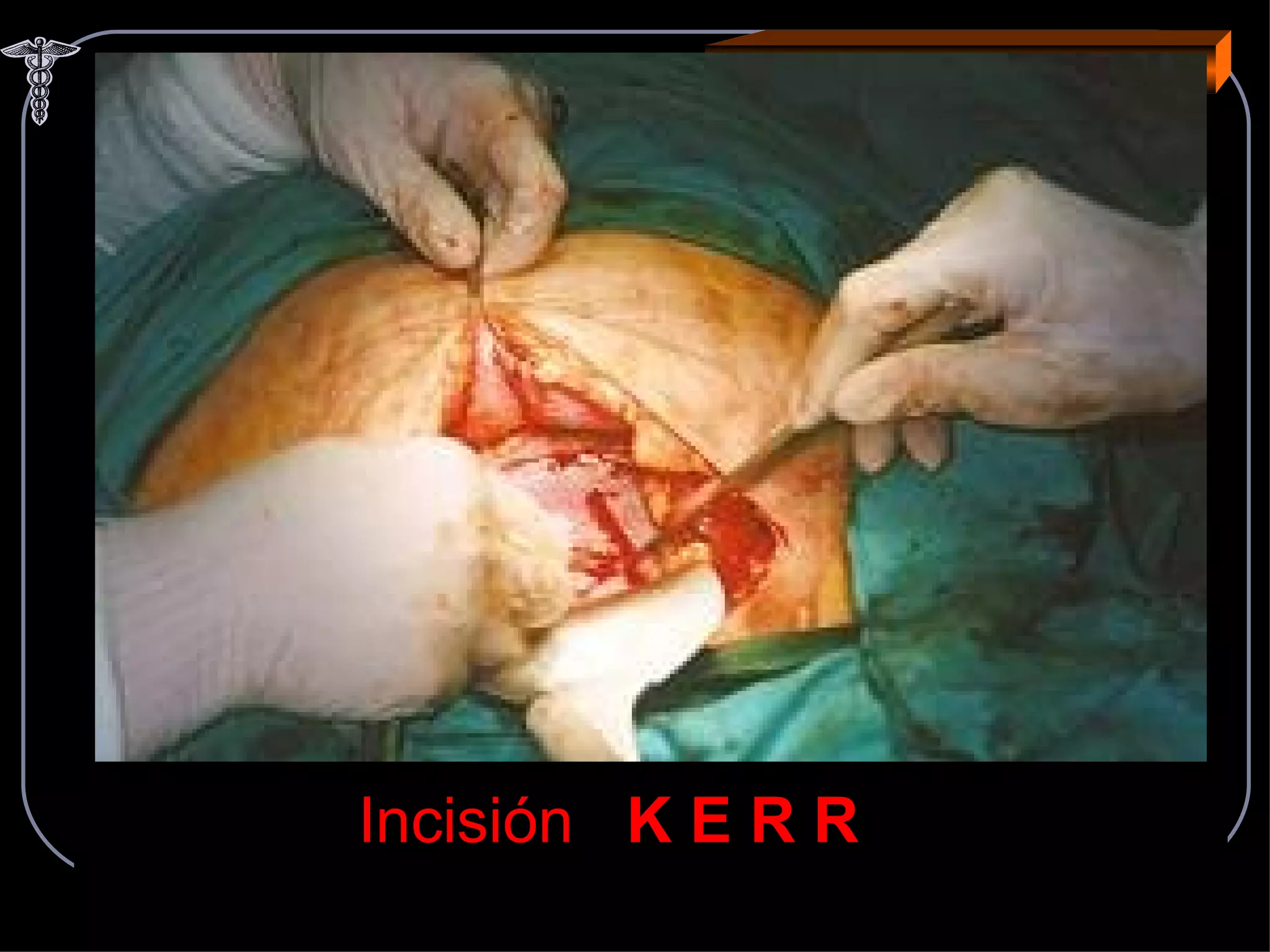 CESAREA Incisión  K E R R 