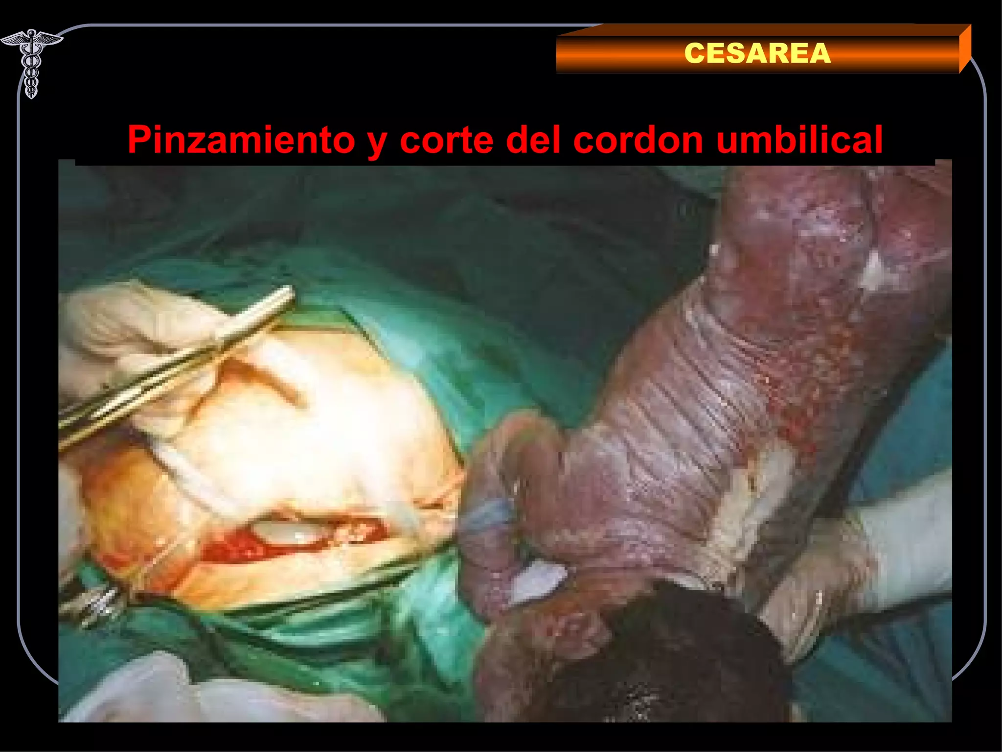 CESAREA Pinzamiento y corte del cordon umbilical 