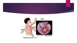 Toracoiscopia Diagnostic and Therapeutic Possibilities of Thoracoscopy in Case of ur.pptx