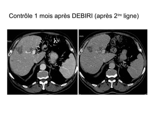 Contrôle 1 mois après DEBIRI (après 2ème
ligne)
 