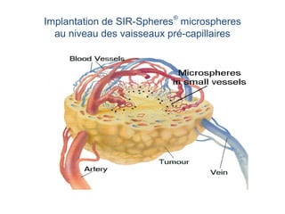 Implantation de SIR-Spheres
®
microspheres
au niveau des vaisseaux pré-capillaires
 