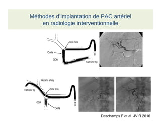 Méthodes d’implantation de PAC artériel
en radiologie interventionnelle
Deschamps F et al. JVIR 2010
 