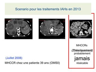 (Juillet 2008)
MHCCR chez une patiente 39 ans (OMS0)
MHCCRs
(Théoriquement)
probablement
jamais
résécable
Scenario pour les traitements IAHs en 2013
 