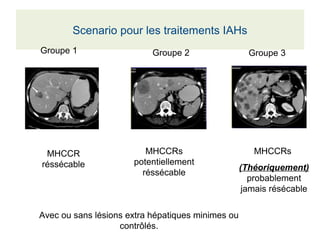 Scenario pour les traitements IAHs
Groupe 1 Groupe 2 Groupe 3
MHCCR 
réssécable
MHCCRs 
potentiellement 
réssécable
MHCCRs 
(Théoriquement) 
probablement 
jamais résécable
Avec ou sans lésions extra hépatiques minimes ou 
contrôlés.
 