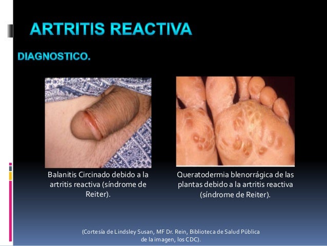 Artritis Gotosa