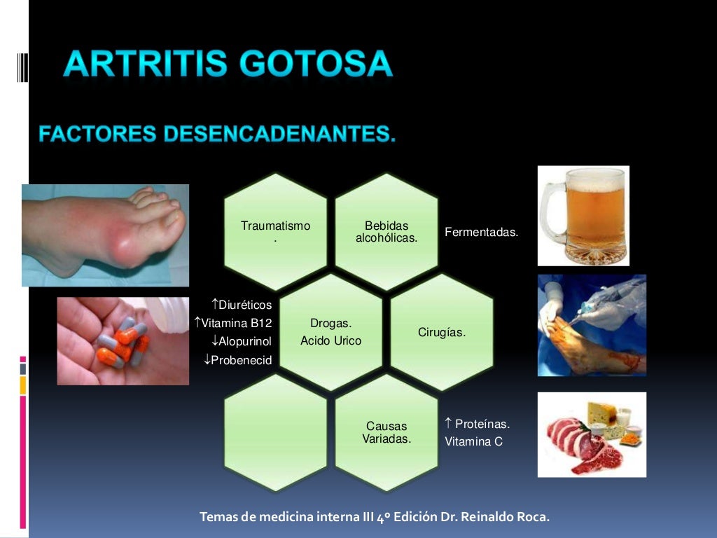Artritis Gotosa