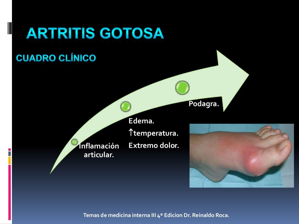 Artritis Gotosa