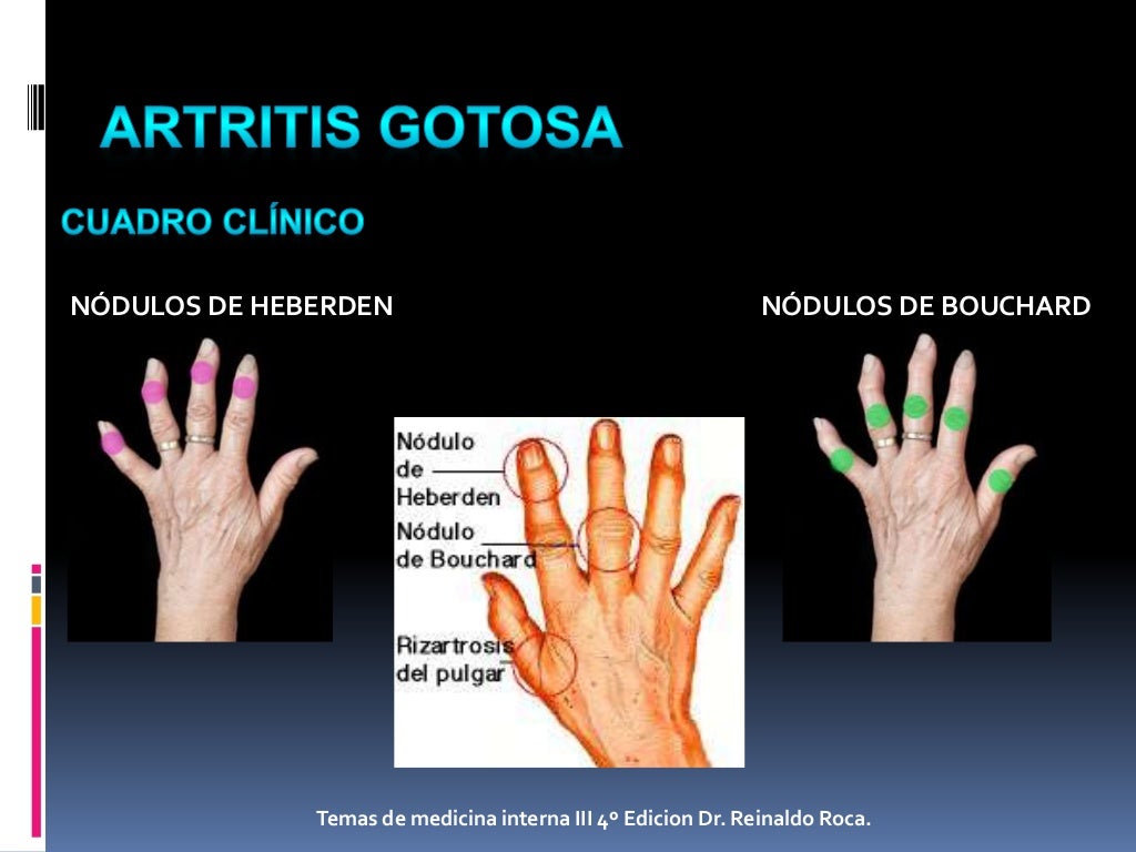 Artritis Gotosa