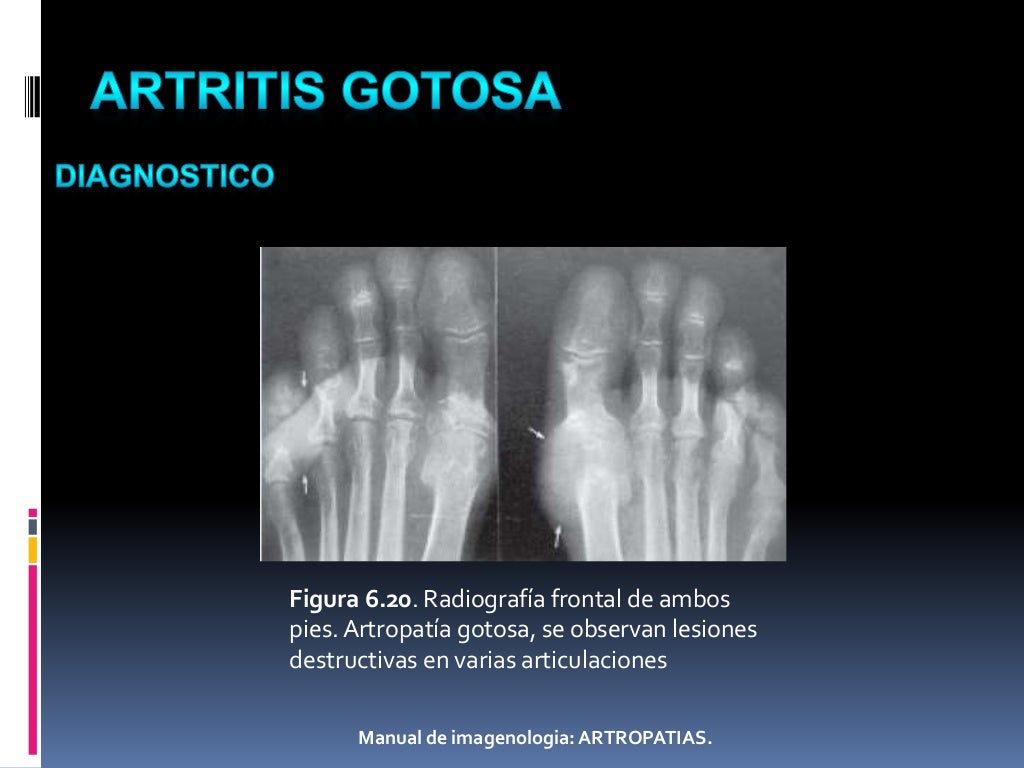 Artritis Gotosa