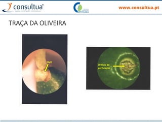 TRAÇA DA OLIVEIRA
OVO
Orifício de
perfuração
 