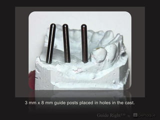 3 mm x 8 mm guide posts placed in holes in the cast.
 