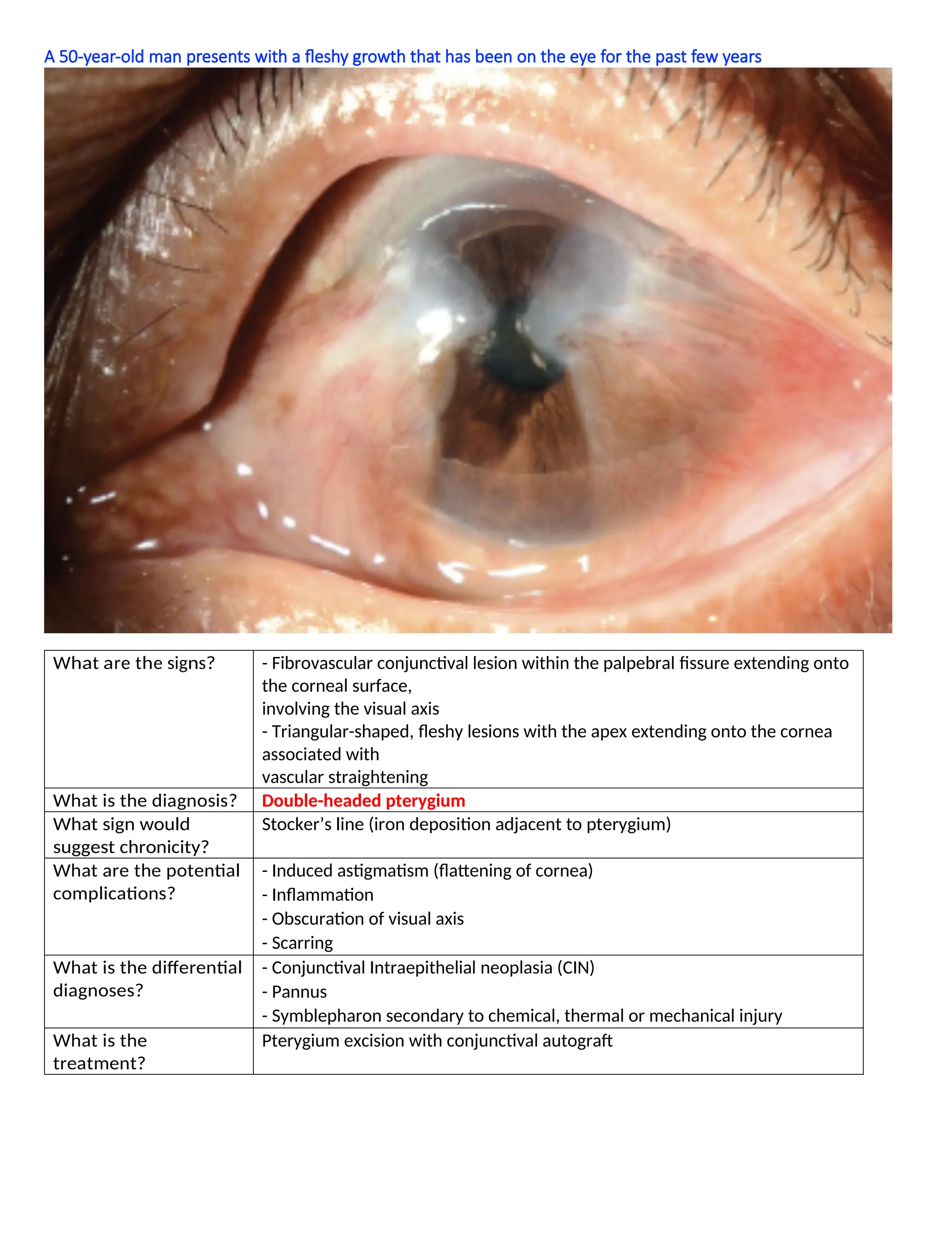 A 50-year-old man presents with a fleshy growth that has been on the eye for the past few years
What are the signs? - Fibrovascular conjunctival lesion within the palpebral fissure extending onto
the corneal surface,
involving the visual axis
- Triangular-shaped, fleshy lesions with the apex extending onto the cornea
associated with
vascular straightening
What is the diagnosis? Double-headed pterygium
What sign would
suggest chronicity?
Stocker’s line (iron deposition adjacent to pterygium)
What are the potential
complications?
- Induced astigmatism (flattening of cornea)
- Inflammation
- Obscuration of visual axis
- Scarring
What is the differential
diagnoses?
- Conjunctival Intraepithelial neoplasia (CIN)
- Pannus
- Symblepharon secondary to chemical, thermal or mechanical injury
What is the
treatment?
Pterygium excision with conjunctival autograft
 
