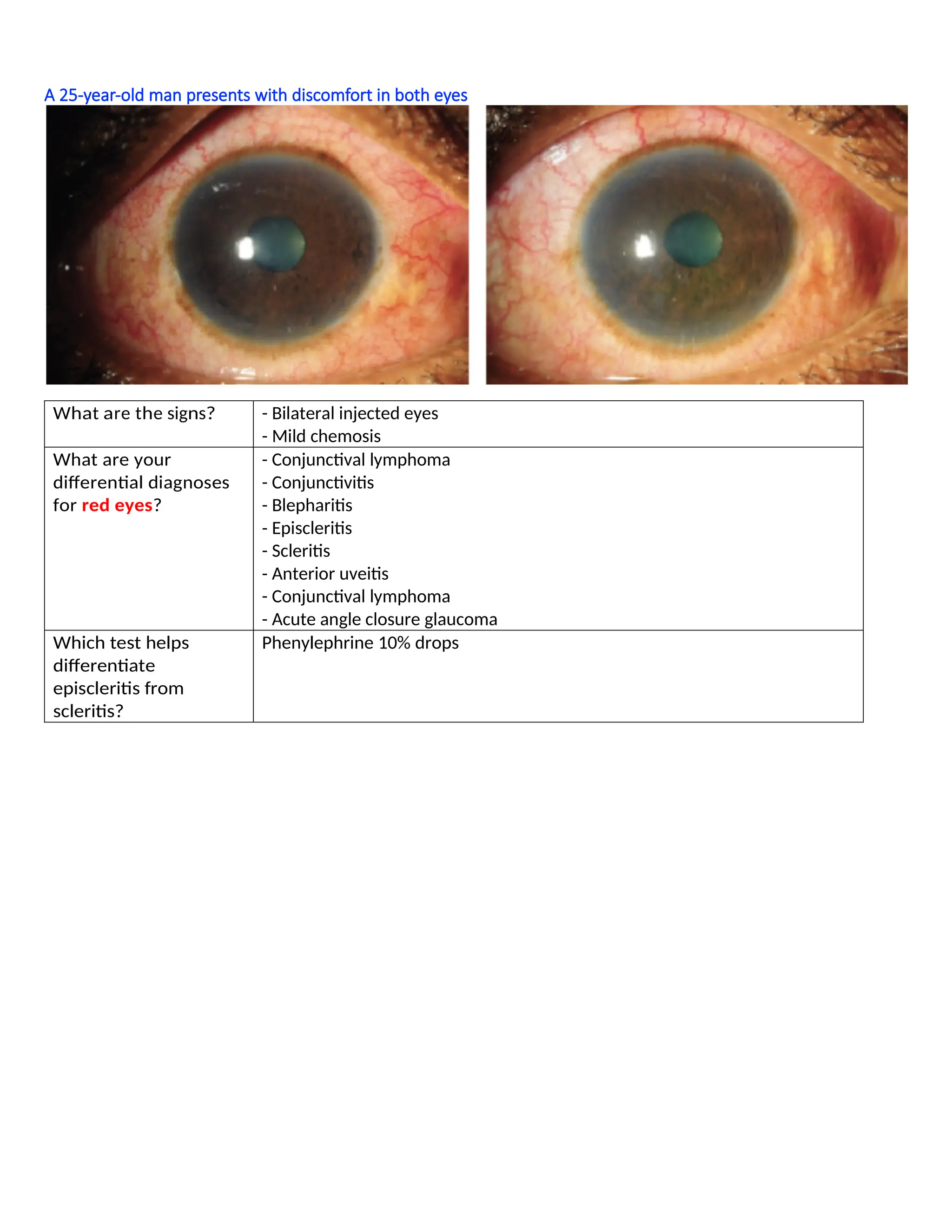 A 25-year-old man presents with discomfort in both eyes
What are the signs? - Bilateral injected eyes
- Mild chemosis
What are your
differential diagnoses
for red eyes?
- Conjunctival lymphoma
- Conjunctivitis
- Blepharitis
- Episcleritis
- Scleritis
- Anterior uveitis
- Conjunctival lymphoma
- Acute angle closure glaucoma
Which test helps
differentiate
episcleritis from
scleritis?
Phenylephrine 10% drops
 
