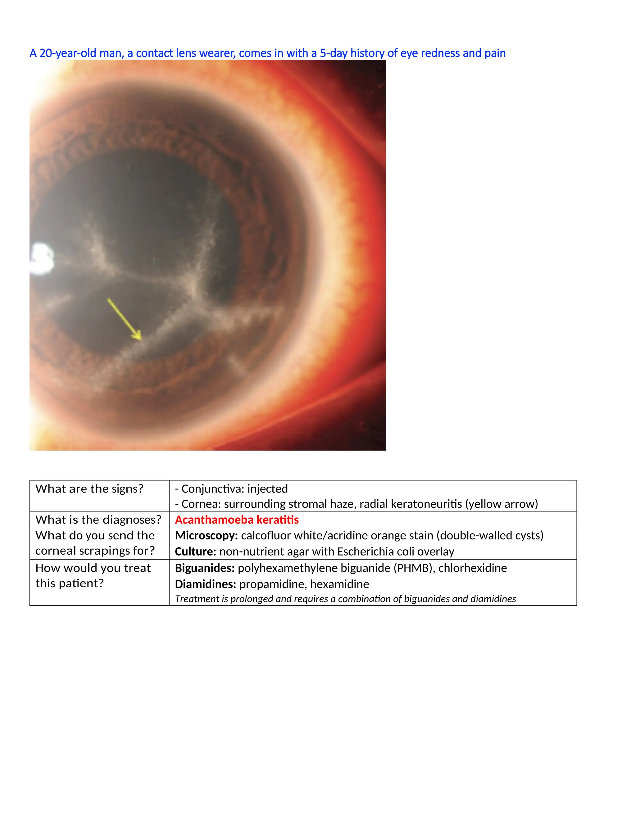 A 20-year-old man, a contact lens wearer, comes in with a 5-day history of eye redness and pain
What are the signs? - Conjunctiva: injected
- Cornea: surrounding stromal haze, radial keratoneuritis (yellow arrow)
What is the diagnoses? Acanthamoeba keratitis
What do you send the
corneal scrapings for?
Microscopy: calcofluor white/acridine orange stain (double-walled cysts)
Culture: non-nutrient agar with Escherichia coli overlay
How would you treat
this patient?
Biguanides: polyhexamethylene biguanide (PHMB), chlorhexidine
Diamidines: propamidine, hexamidine
Treatment is prolonged and requires a combination of biguanides and diamidines
 