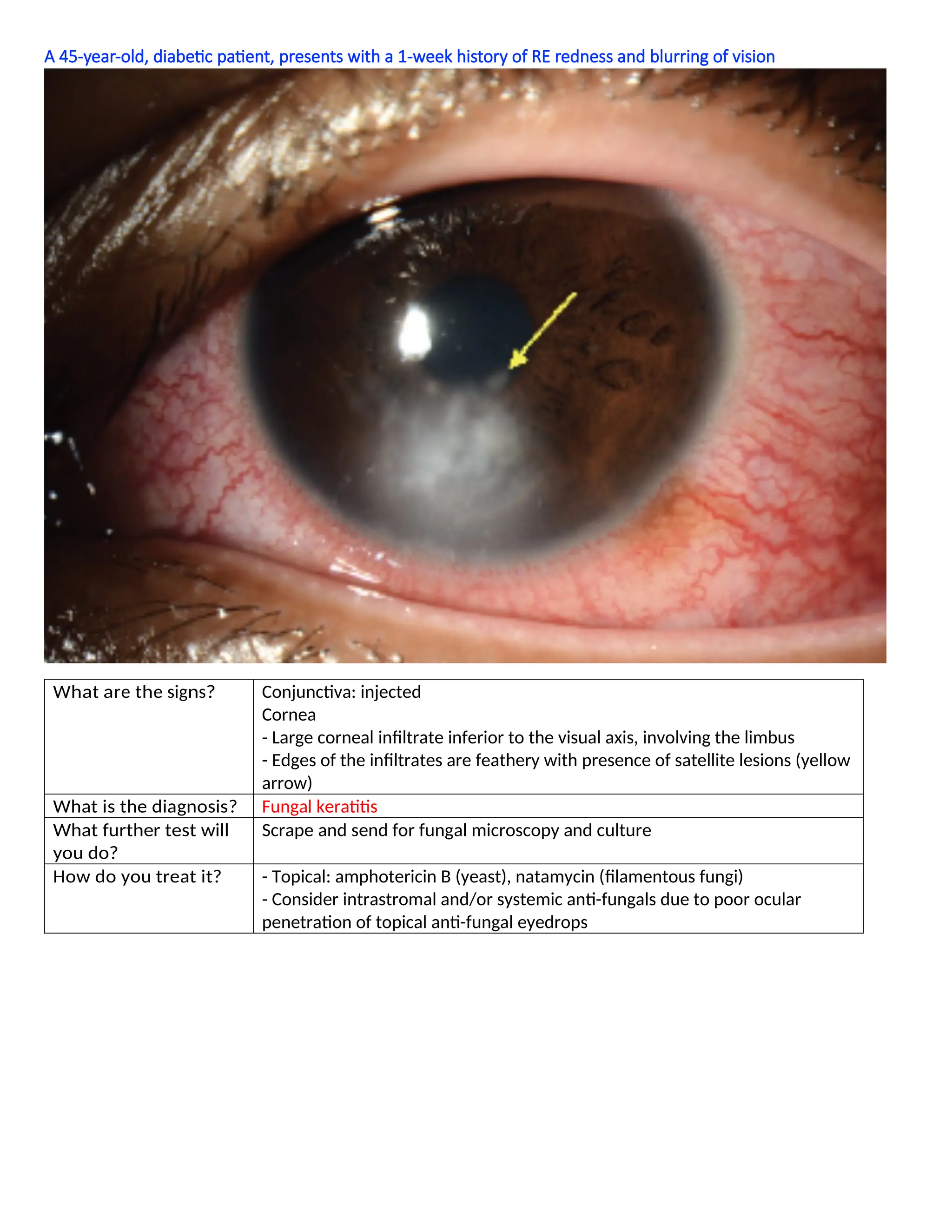 A 45-year-old, diabetic patient, presents with a 1-week history of RE redness and blurring of vision
What are the signs? Conjunctiva: injected
Cornea
- Large corneal infiltrate inferior to the visual axis, involving the limbus
- Edges of the infiltrates are feathery with presence of satellite lesions (yellow
arrow)
What is the diagnosis? Fungal keratitis
What further test will
you do?
Scrape and send for fungal microscopy and culture
How do you treat it? - Topical: amphotericin B (yeast), natamycin (filamentous fungi)
- Consider intrastromal and/or systemic anti-fungals due to poor ocular
penetration of topical anti-fungal eyedrops
 