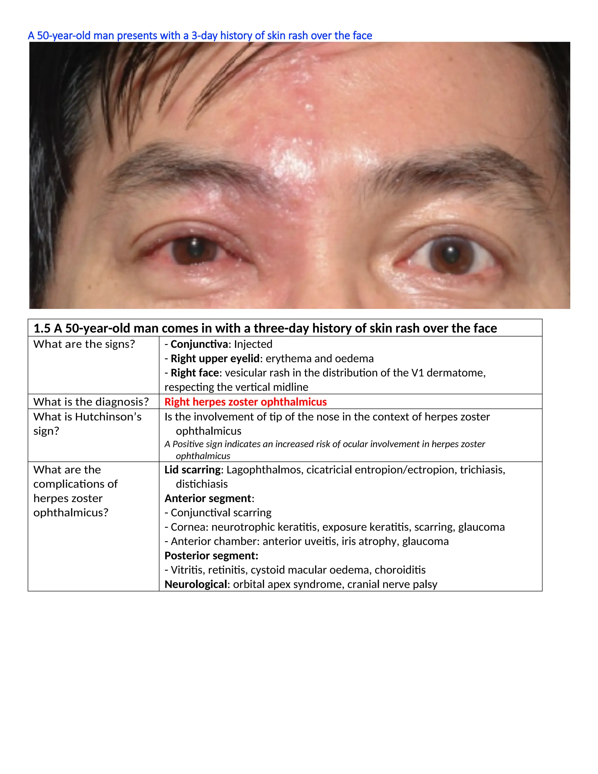 A 50-year-old man presents with a 3-day history of skin rash over the face
1.5 A 50-year-old man comes in with a three-day history of skin rash over the face
What are the signs? - Conjunctiva: Injected
- Right upper eyelid: erythema and oedema
- Right face: vesicular rash in the distribution of the V1 dermatome,
respecting the vertical midline
What is the diagnosis? Right herpes zoster ophthalmicus
What is Hutchinson’s
sign?
Is the involvement of tip of the nose in the context of herpes zoster
ophthalmicus
A Positive sign indicates an increased risk of ocular involvement in herpes zoster
ophthalmicus
What are the
complications of
herpes zoster
ophthalmicus?
Lid scarring: Lagophthalmos, cicatricial entropion/ectropion, trichiasis,
distichiasis
Anterior segment:
- Conjunctival scarring
- Cornea: neurotrophic keratitis, exposure keratitis, scarring, glaucoma
- Anterior chamber: anterior uveitis, iris atrophy, glaucoma
Posterior segment:
- Vitritis, retinitis, cystoid macular oedema, choroiditis
Neurological: orbital apex syndrome, cranial nerve palsy
 