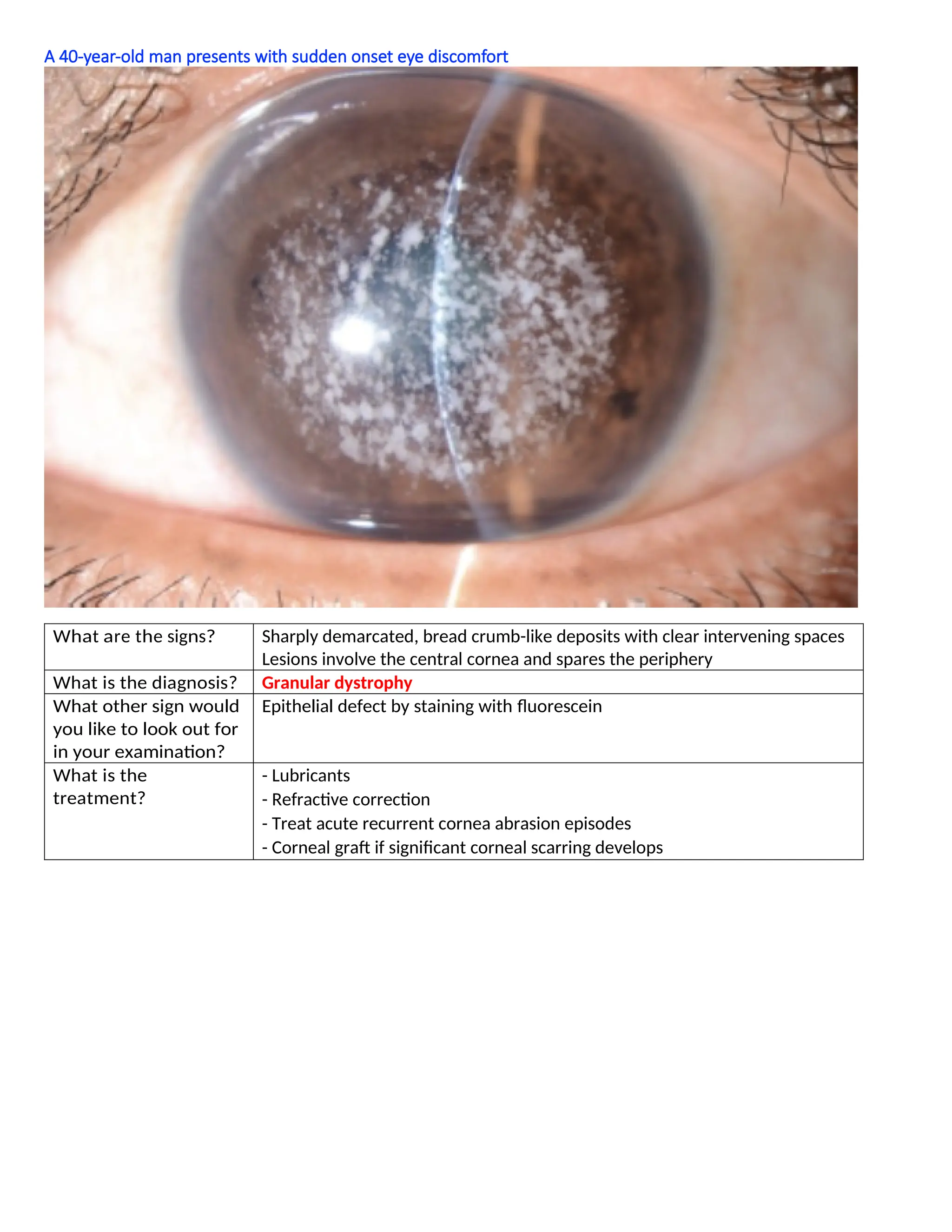 A 40-year-old man presents with sudden onset eye discomfort
What are the signs? Sharply demarcated, bread crumb-like deposits with clear intervening spaces
Lesions involve the central cornea and spares the periphery
What is the diagnosis? Granular dystrophy
What other sign would
you like to look out for
in your examination?
Epithelial defect by staining with fluorescein
What is the
treatment?
- Lubricants
- Refractive correction
- Treat acute recurrent cornea abrasion episodes
- Corneal graft if significant corneal scarring develops
 