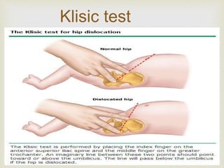 Klisic test 
 
 