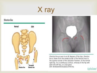 X ray 
 
 