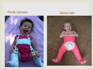 Pavlik harness Spica cast 
 
 