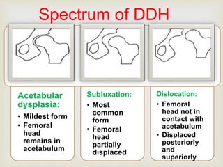 Spectrum of DDH 
 
Acetabular 
dysplasia: 
• Mildest form 
• Femoral 
head 
remains in 
acetabulum 
Subluxation: 
• Most 
common 
form 
• Femoral 
head 
partially 
displaced 
Dislocation: 
• Femoral 
head not in 
contact with 
acetabulum 
• Displaced 
posteriorly 
and 
superiorly 
 