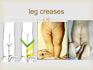 leg creases 
 
 