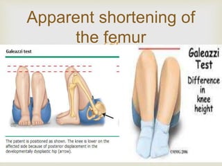 Apparent shortening of 
the femur 
 
 