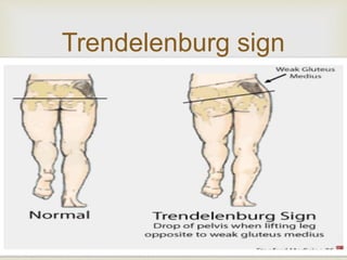 Trendelenburg sign 
 
 