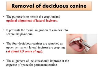 Removal of deciduous canine
• The purpose is to permit the eruption and
optimal alignment of lateral incisors.
• It prevents the mesial migration of canines into
severe malpositions.
• The four deciduous canines are removed as
upper permanent lateral incisors are erupting
(at about 8.5 years of age).
• The alignment of incisors should improve at the
expense of space for permanent canine
 