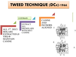 TWEED TECHNIQUE (DC4)-1966
ALL 1ST DECI
MOLARS
EXTRACTED (8
YRS)
MAINTAIN
CANINE
EXTRACT
ALL
PREMOLARS
WITH DECI
CANINE
CANINE
AND
INCISORS
ALIGNED
4-10 Month
 