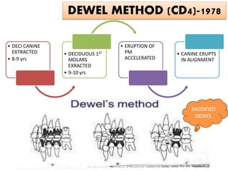 DEWEL METHOD (CD4)-1978
• DECI CANINE
EXTRACTED
• 8-9 yrs
• DECIDUOUS 1ST
MOLARS
EXRACTED
• 9-10 yrs
• ERUPTION OF
PM
ACCELERATED
• CANINE ERUPTS
IN ALIGNMENT
MODIFIED
DEWEL
 