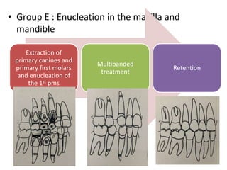 • Group E : Enucleation in the maxilla and
mandible
Extraction of
primary canines and
primary first molars
and enucleation of
the 1st pms
Multibanded
treatment
Retention
 