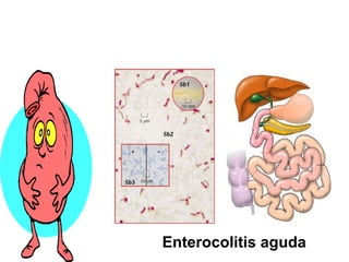Enterocolitis aguda
 